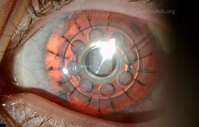 Une cornée artificielle implantée dans un oeil